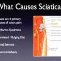Sciatica Causes – What Causes Sciatic Pain?