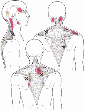Neck pain and Shoulder Pain
