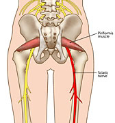 sciatica causes